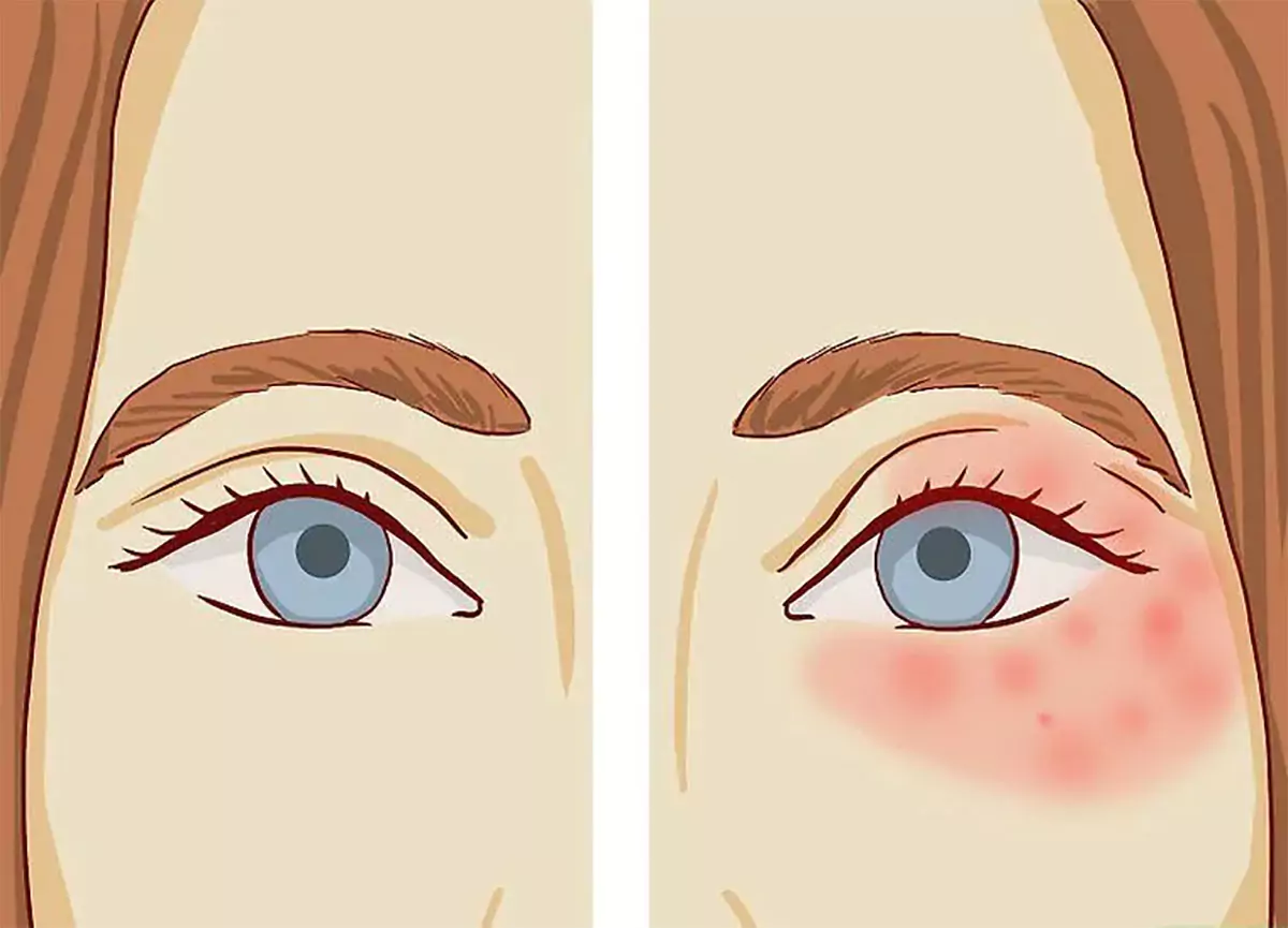 درمان خشکی و خارش پوست دور چشم چیست؟